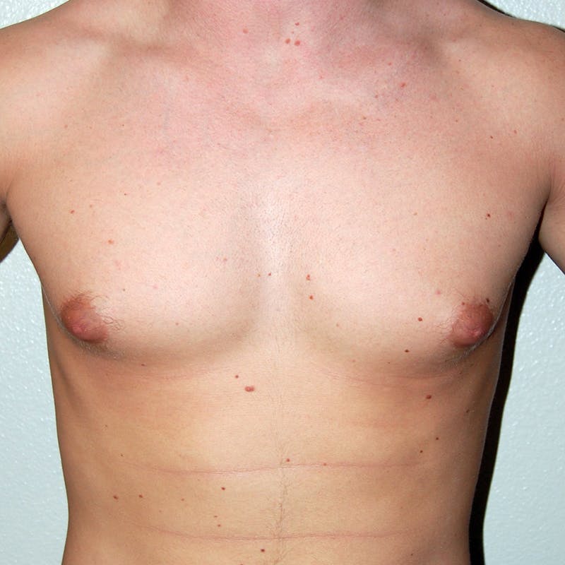 Gynecomastia Before & After Gallery - Patient 502741 - Image 1