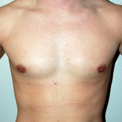 Gynecomastia Before & After Gallery - Patient 502741 - Image 2