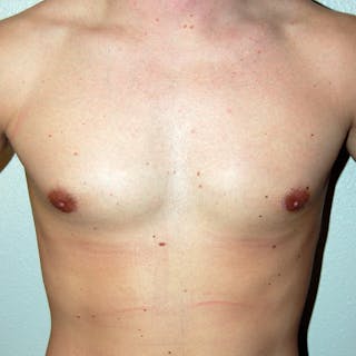 Gynecomastia Before & After Gallery - Patient 502741 - Image 2