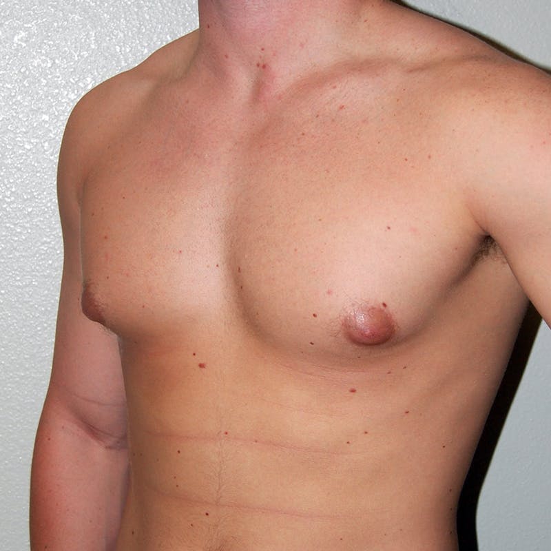 Gynecomastia Before & After Gallery - Patient 502741 - Image 3