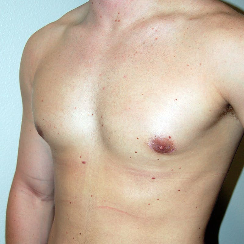 Gynecomastia Before & After Gallery - Patient 502741 - Image 4