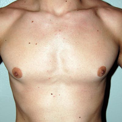 Gynecomastia Before & After Gallery - Patient 233464 - Image 1