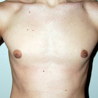Gynecomastia Before & After Gallery - Patient 233464 - Image 2