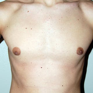 Gynecomastia Before & After Gallery - Patient 233464 - Image 2