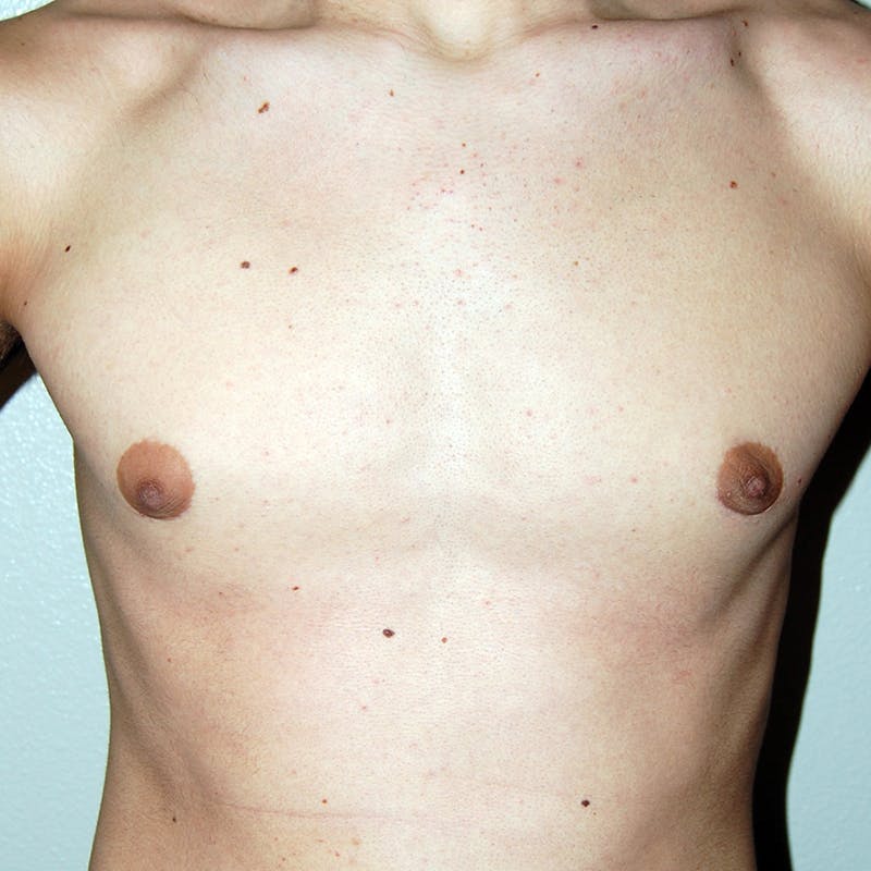 Gynecomastia Before & After Gallery - Patient 233464 - Image 2