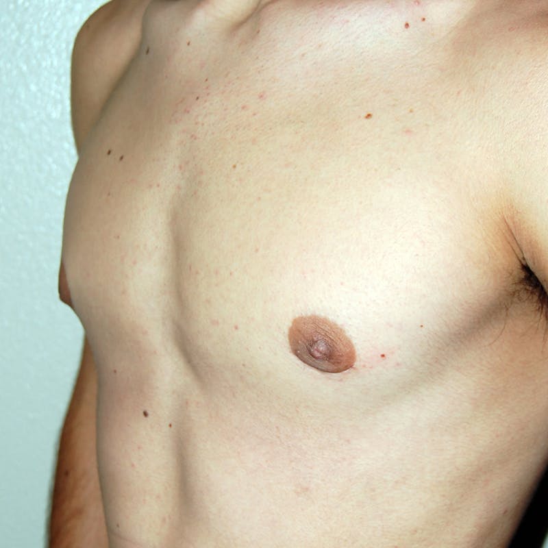 Gynecomastia Before & After Gallery - Patient 233464 - Image 4