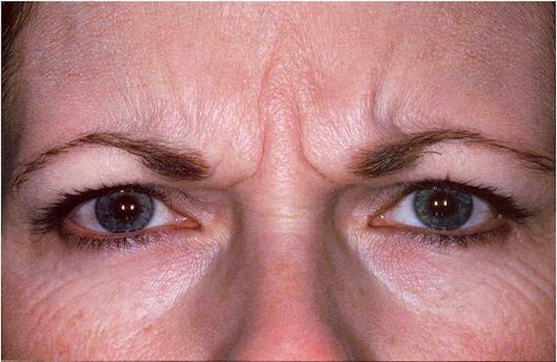 Botox Before & After Gallery - Patient 174126 - Image 1