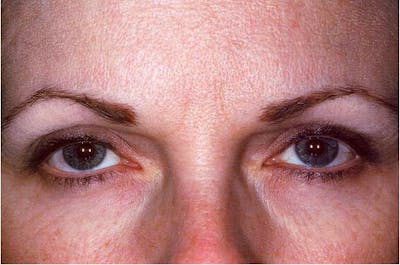 Botox Before & After Gallery - Patient 174126 - Image 2