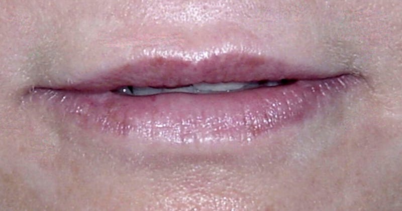 Lip Augmentation Before & After Gallery - Patient 482791 - Image 1