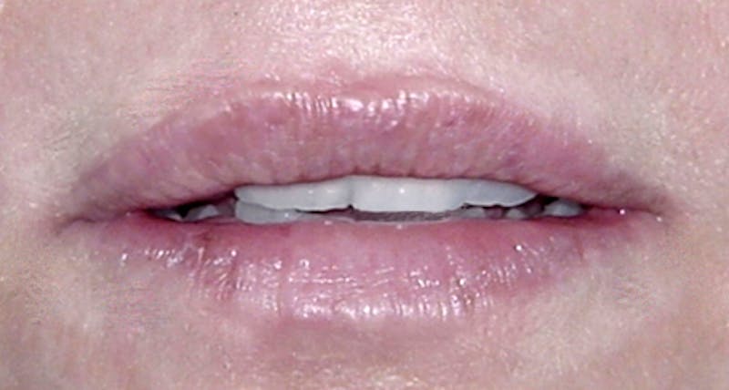 Lip Augmentation Before & After Gallery - Patient 482791 - Image 2