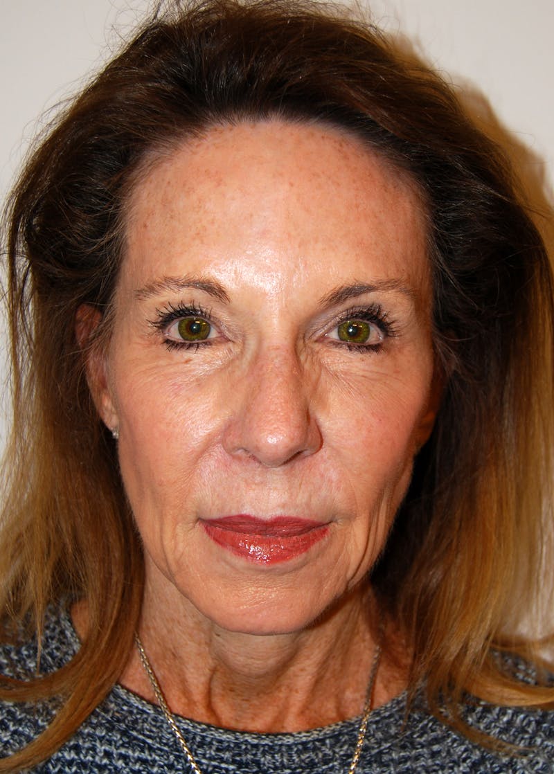 Facelift Before & After Gallery - Patient 151280 - Image 1