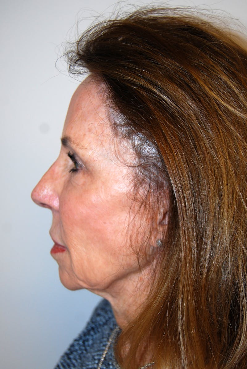 Facelift Before & After Gallery - Patient 151280 - Image 3
