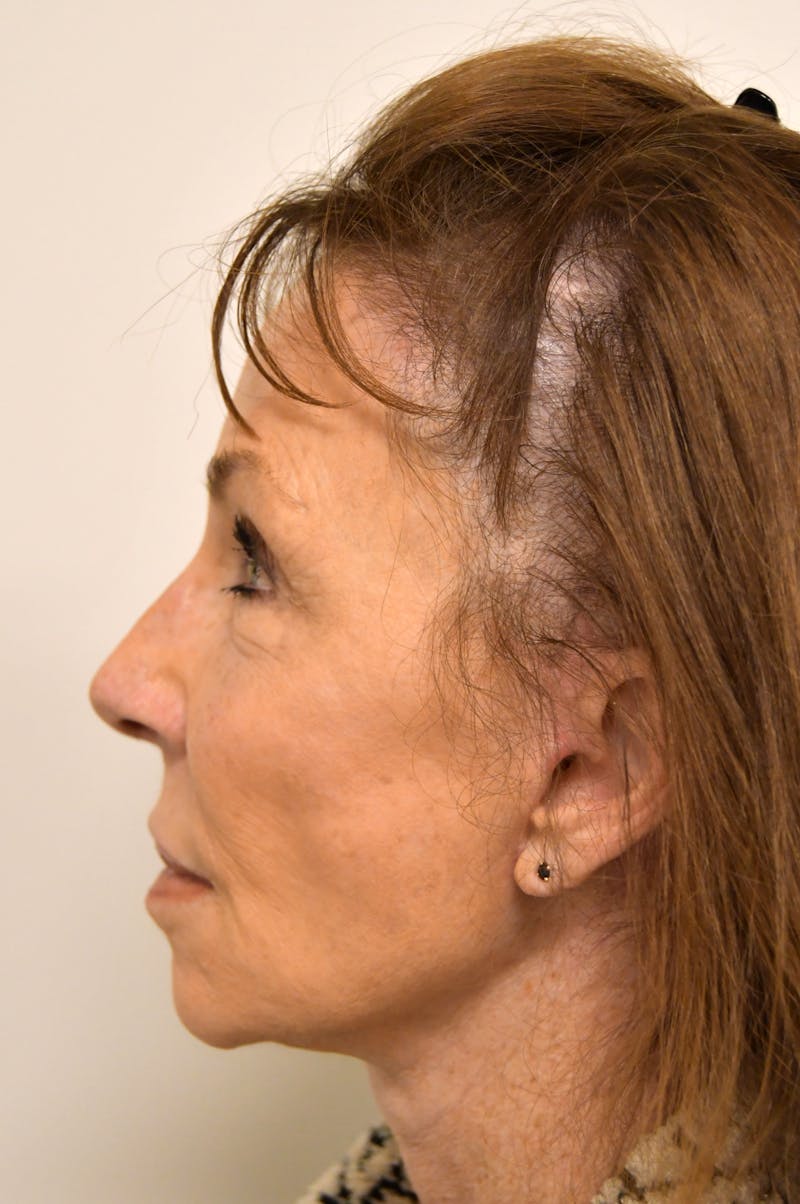 Facelift Before & After Gallery - Patient 151280 - Image 4