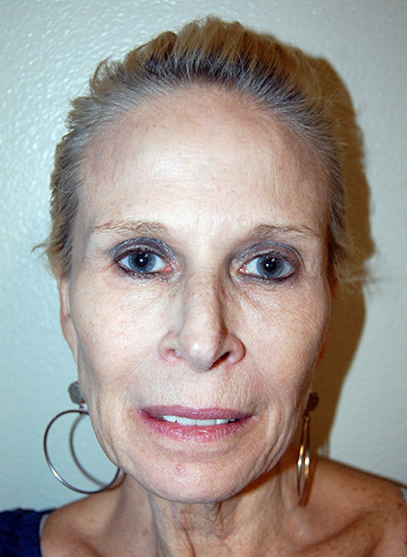 Facelift Before & After Gallery - Patient 255986 - Image 1