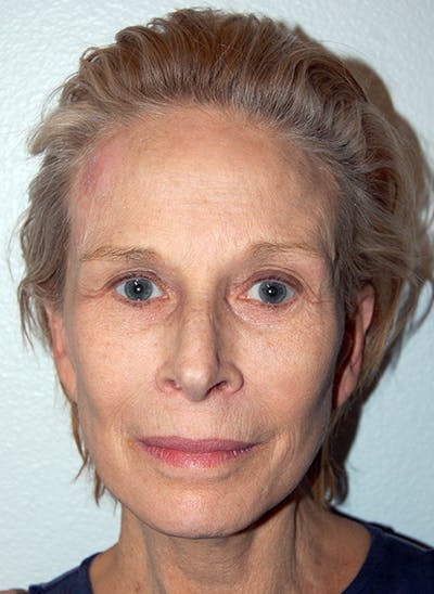Facelift Before & After Gallery - Patient 255986 - Image 2