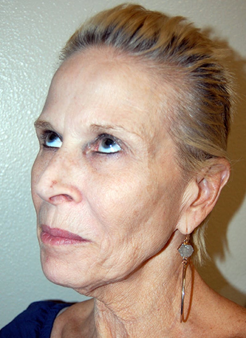 Facelift Before & After Gallery - Patient 255986 - Image 3