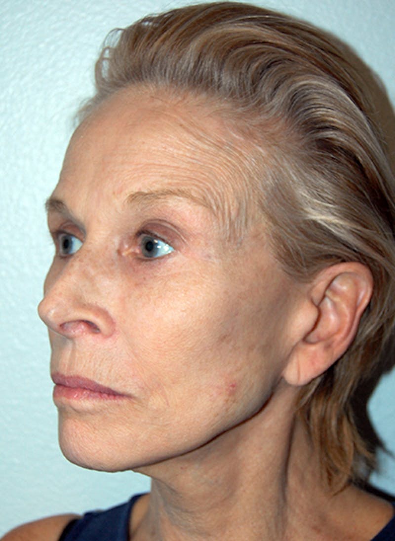 Facelift Before & After Gallery - Patient 255986 - Image 4