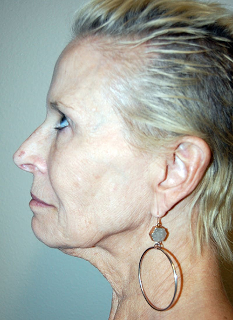 Facelift Before & After Gallery - Patient 255986 - Image 5