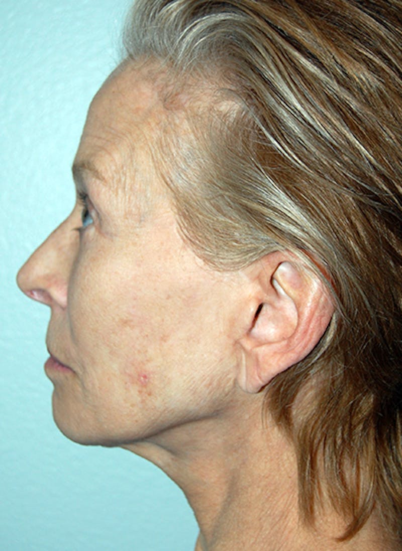Facelift Before & After Gallery - Patient 255986 - Image 6