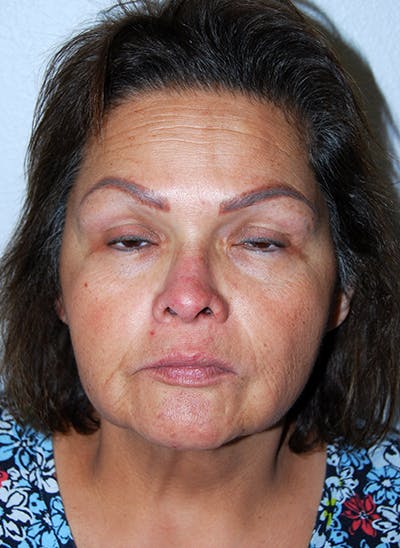 Facelift Before & After Gallery - Patient 353856 - Image 1