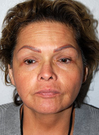 Facelift Before & After Gallery - Patient 353856 - Image 2