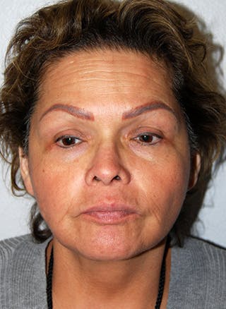 Facelift Before & After Gallery - Patient 353856 - Image 2
