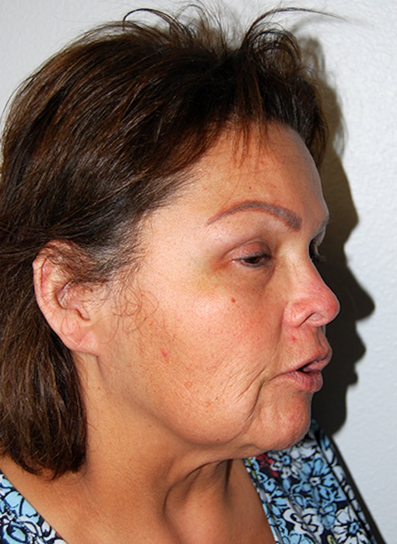 Facelift Before & After Gallery - Patient 353856 - Image 3