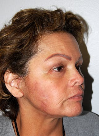 Facelift Before & After Gallery - Patient 353856 - Image 4