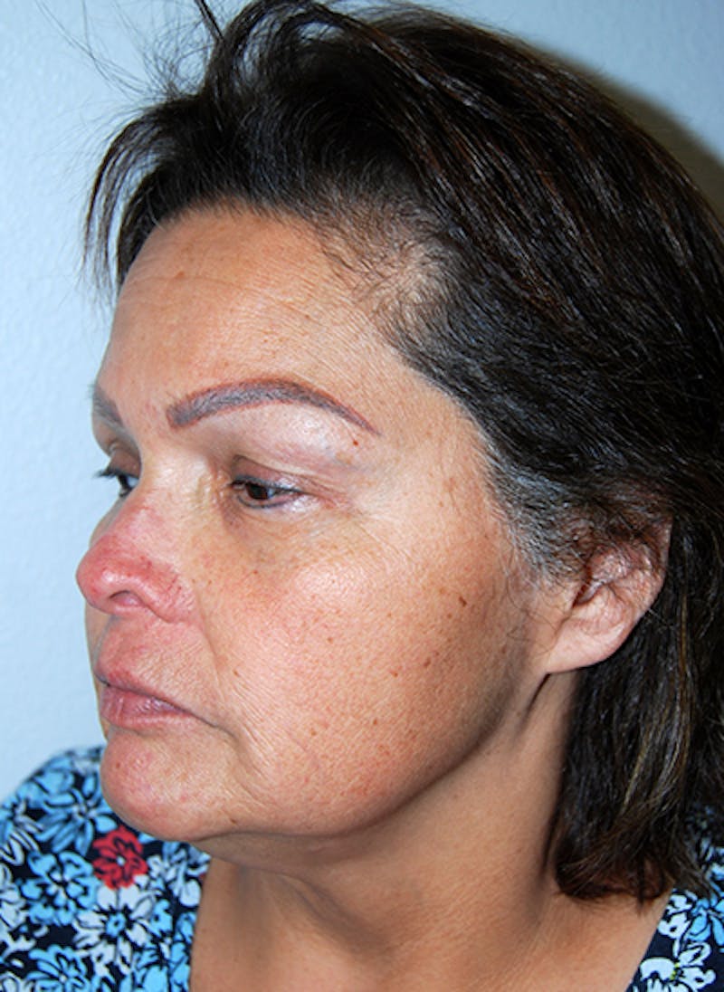 Facelift Before & After Gallery - Patient 353856 - Image 5