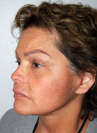 Facelift Before & After Gallery - Patient 353856 - Image 6