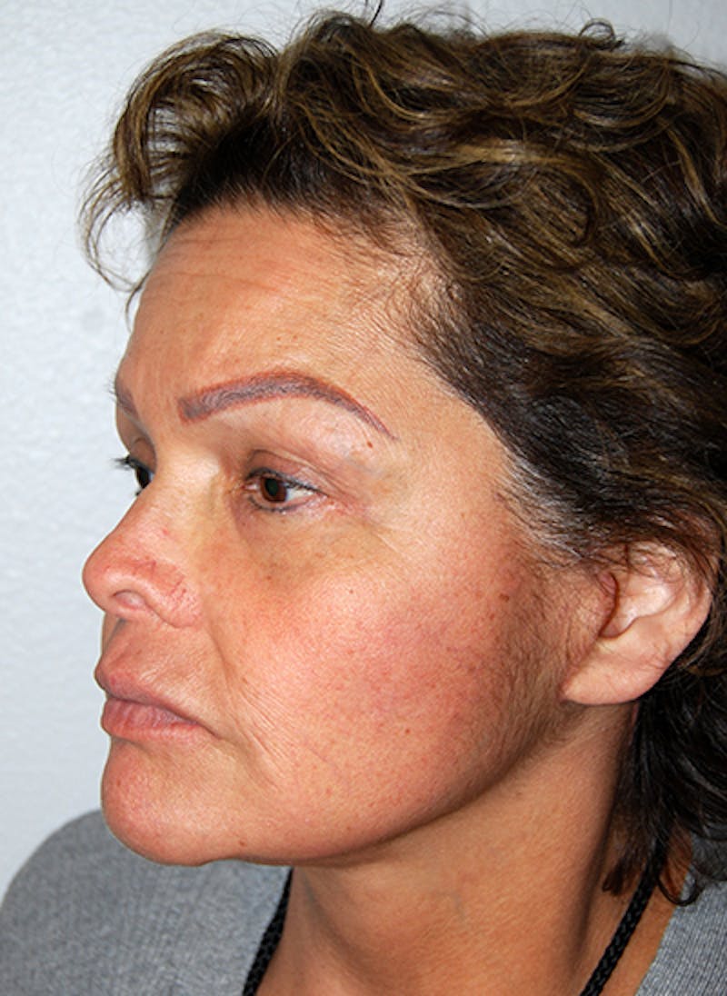 Facelift Before & After Gallery - Patient 353856 - Image 6