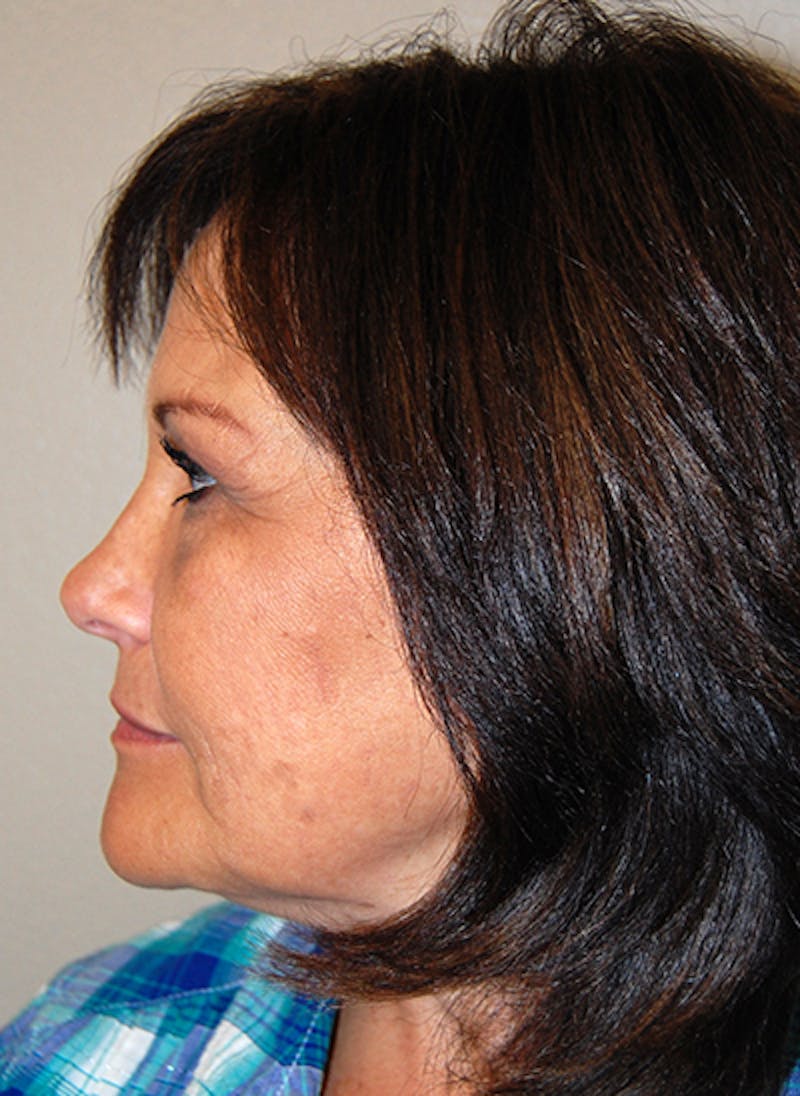 Facelift Before & After Gallery - Patient 394422 - Image 5