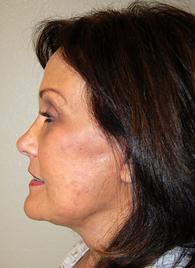 Facelift Before & After Gallery - Patient 394422 - Image 6