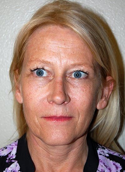 Facelift Before & After Gallery - Patient 363979 - Image 1