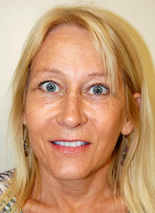 Facelift Before & After Gallery - Patient 363979 - Image 2