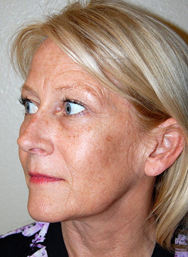 Facelift Before & After Gallery - Patient 363979 - Image 3