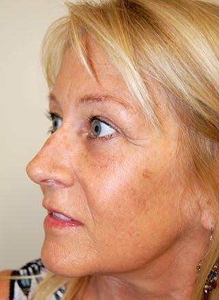 Facelift Before & After Gallery - Patient 363979 - Image 4