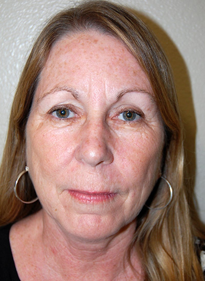 Facelift Before & After Gallery - Patient 418097 - Image 1