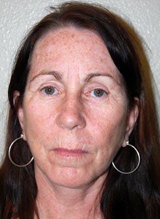 Facelift Before & After Gallery - Patient 418097 - Image 2