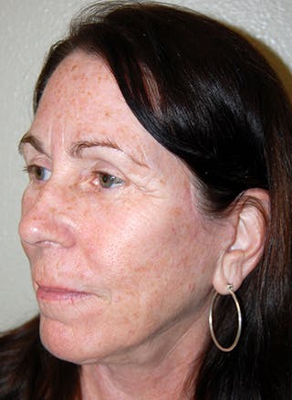 Facelift Before & After Gallery - Patient 418097 - Image 4