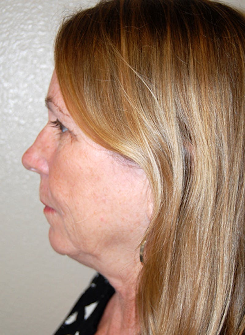 Facelift Before & After Gallery - Patient 418097 - Image 5