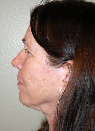 Facelift Before & After Gallery - Patient 418097 - Image 6