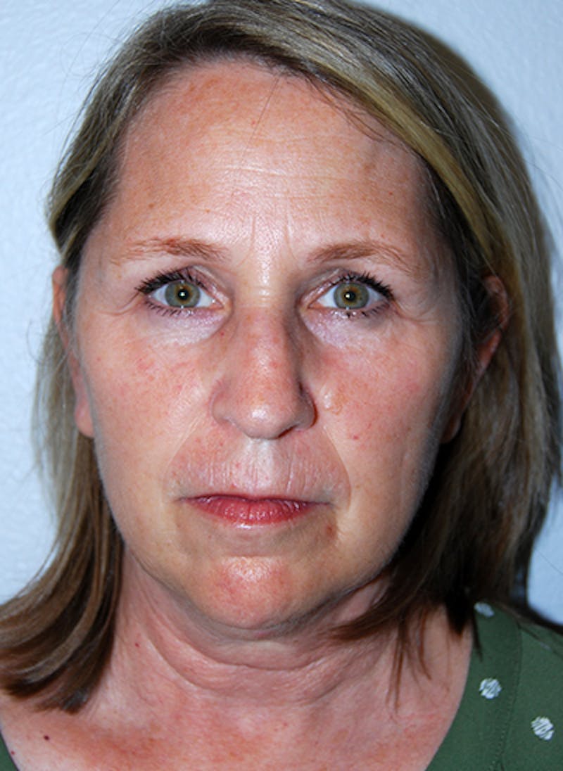 Facelift Before & After Gallery - Patient 351773 - Image 1