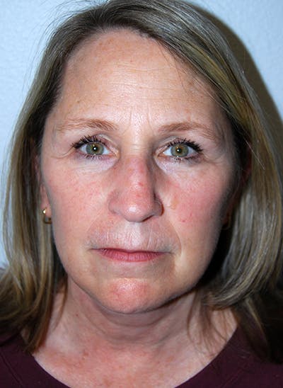 Facelift Before & After Gallery - Patient 351773 - Image 2