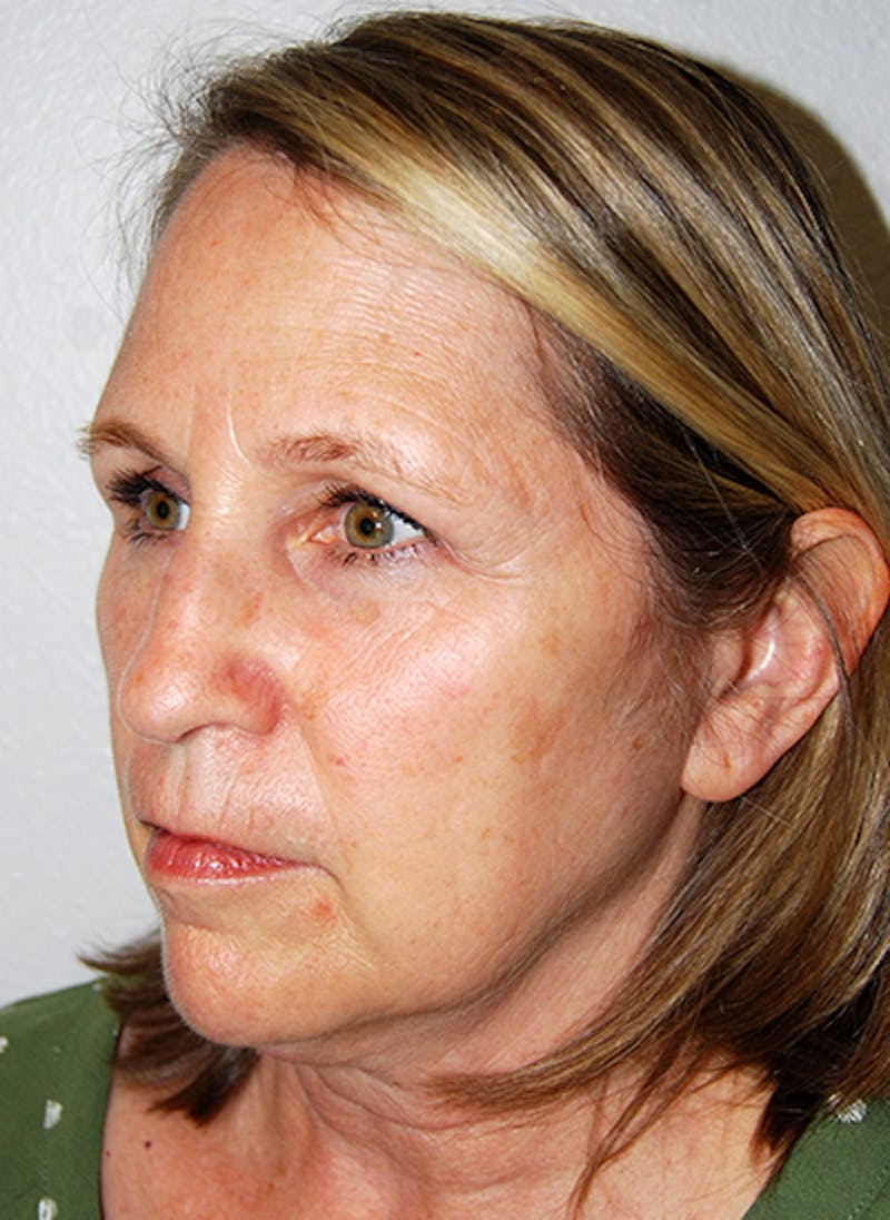 Facelift Before & After Gallery - Patient 351773 - Image 3