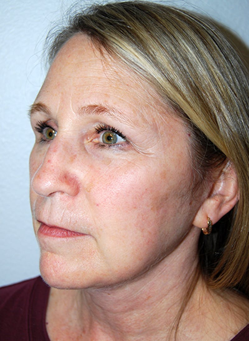 Facelift Before & After Gallery - Patient 351773 - Image 4