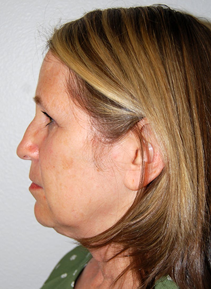 Facelift Before & After Gallery - Patient 351773 - Image 5