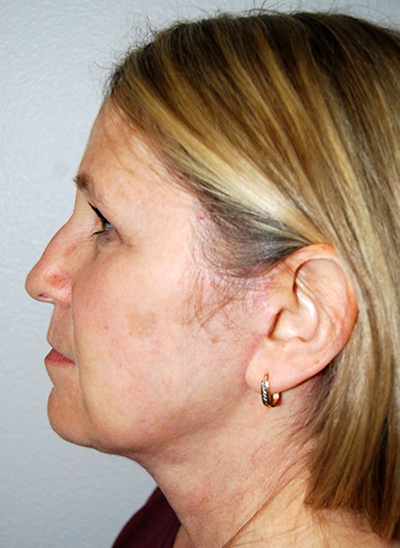 Facelift Before & After Gallery - Patient 351773 - Image 6