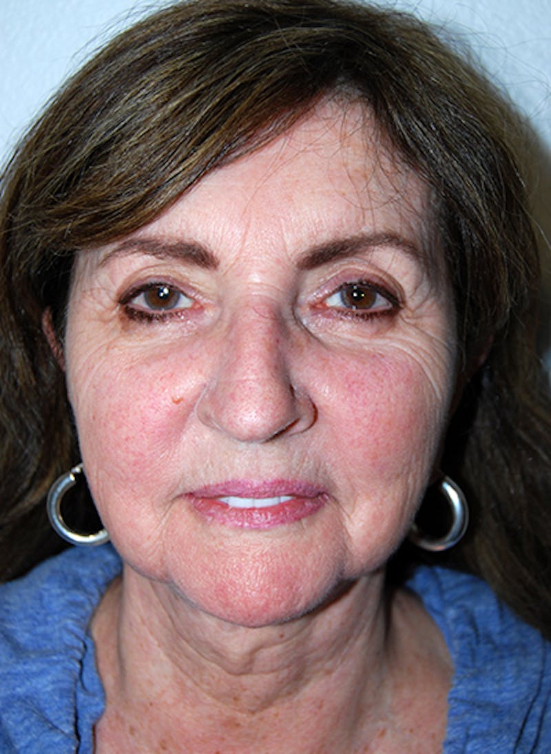 Facelift Before & After Gallery - Patient 109008 - Image 1