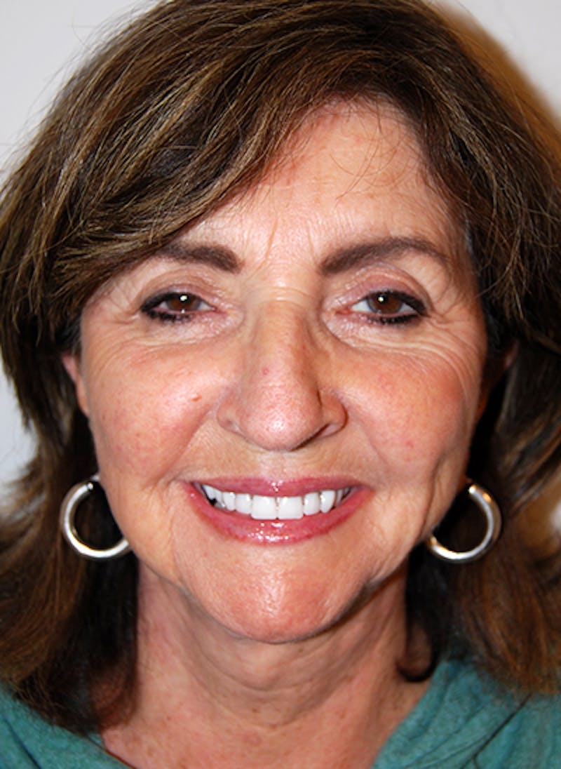 Facelift Before & After Gallery - Patient 109008 - Image 2